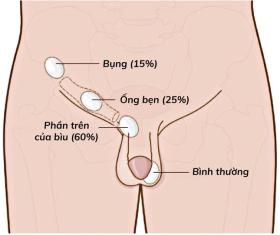  Tại sao tinh hoàn lại bị ẩn và có nguy hiểm không? 