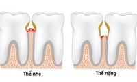  Cao răng, &apos;sát thủ&apos; trong… miệng 